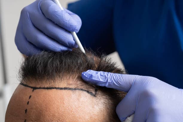 Hair Transplant Turkey Cost at Vivid Clinic: Premium Care for Less