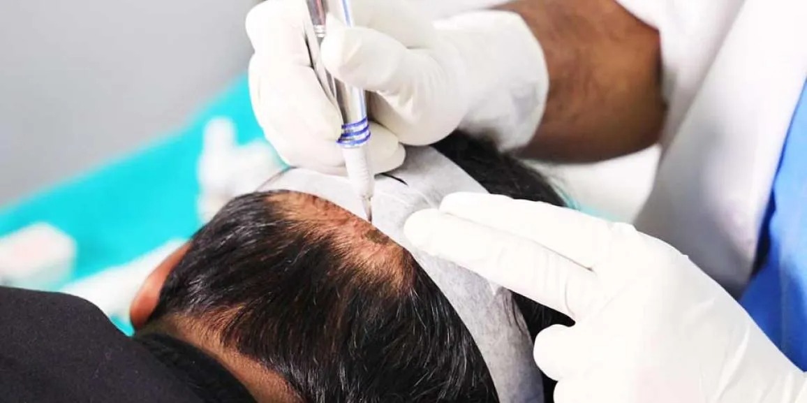 Hair Transplant UK – Real Success Stories from Real Clients
