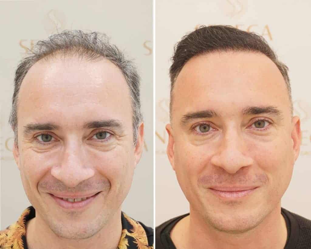Find the Best Hair Transplant UK Clinic for Natural Results